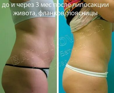 Отзывы липосакции фото