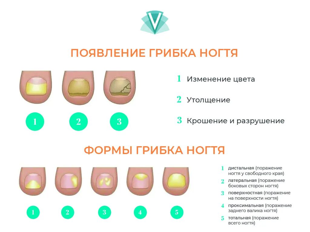 Холизис. Схема лечения (онихомикоз) онихомикоз ногтей. Дистально латеральная форма онихомикоза. Онихолитический грибок ногтей на ногах. Грибковые заболевания ногтей схема.