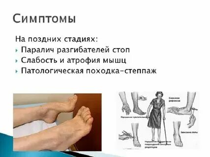 Полинейропатия ног