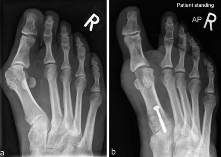 Hallux valgus что это такое