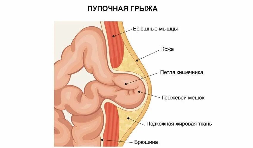 Пупочная грыжа что можно кушать. Пупочное кольцо анатомия строение. Межпупо пупочная грыжа. Нагноившаяся пупочная грыжа. Грыжевые ворота пупочной грыжи.