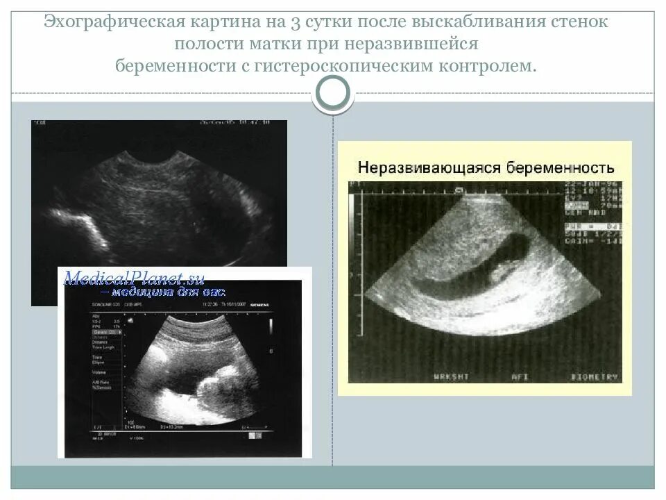 Неразвивающаяся беременность 7 недель. Не развивающая беременность. Неразвивающаяся беременность УЗИ. Неразвивающаяся беременность причины.