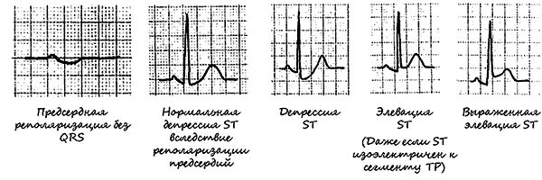 Эпизод депрессии st. Косонисходящая депрессия сегмента St. Косовосходящая депрессия сегмента St на ЭКГ. Элевация сегмента St на ЭКГ. Косовосходящая элевация сегмента St на ЭКГ.