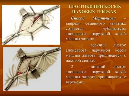 Паховая грыжа сколько