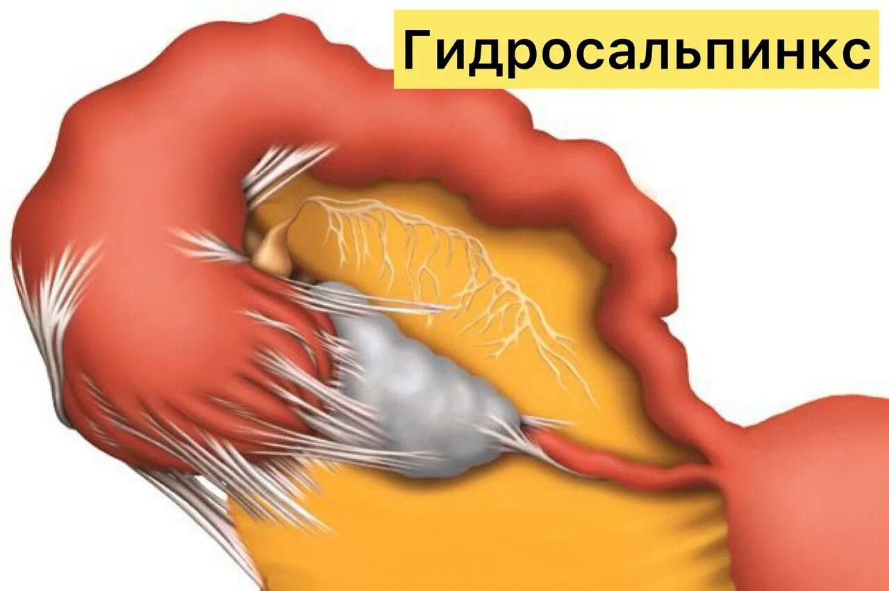 Гидросальпинкс лечение операции. Гидросальпинкс маточных труб. Гидросальпинкс пиосальпинкс. Перекрут гидросальпинкса. Гигантский гидросальпинкс.