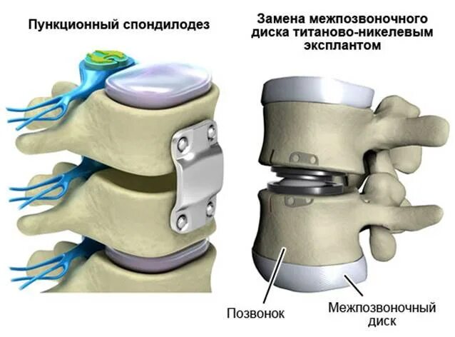 Грыжа межпозвоночного диска операция. Грыжа межпозвонкового диска шейного отдела. Замена межпозвоночного диска поясничного отдела. Грыжа диска позвоночника поясничного отдела операция. После операция грыжа диска