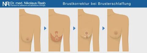Korrektur von Hängebrüsten durch Bruststraffung.