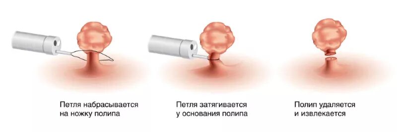 Операция по удалению цервикального полипа