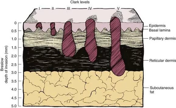 Уровни инвазии меланомы по Кларку. Степень инвазии по Кларку меланома. 2 Уровень инвазии по Кларку меланома. Классификация меланомы по Бреслоу. Степень инвазии