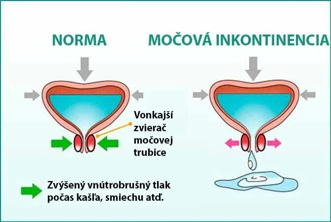 Непроизвольное Мочеиспускание У Женщин Во Время Секса