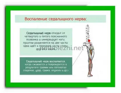Защемление седалищного нерва лечение у женщин уколы