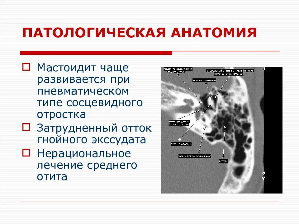 Мастоидит сосцевидного отростка. Воспаление сосцевидного отростка. Экссудат в сосцевидном отростке. Утолщение слизистой сосцевидного отростка