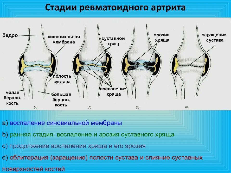 Артрит рентгенологические стадии. Паннус ревматоидный артрит. Стадии ревматоидного артрита паннус. Степени артрита по Штейнброкеру. Стадии при ревматоидном артрите.