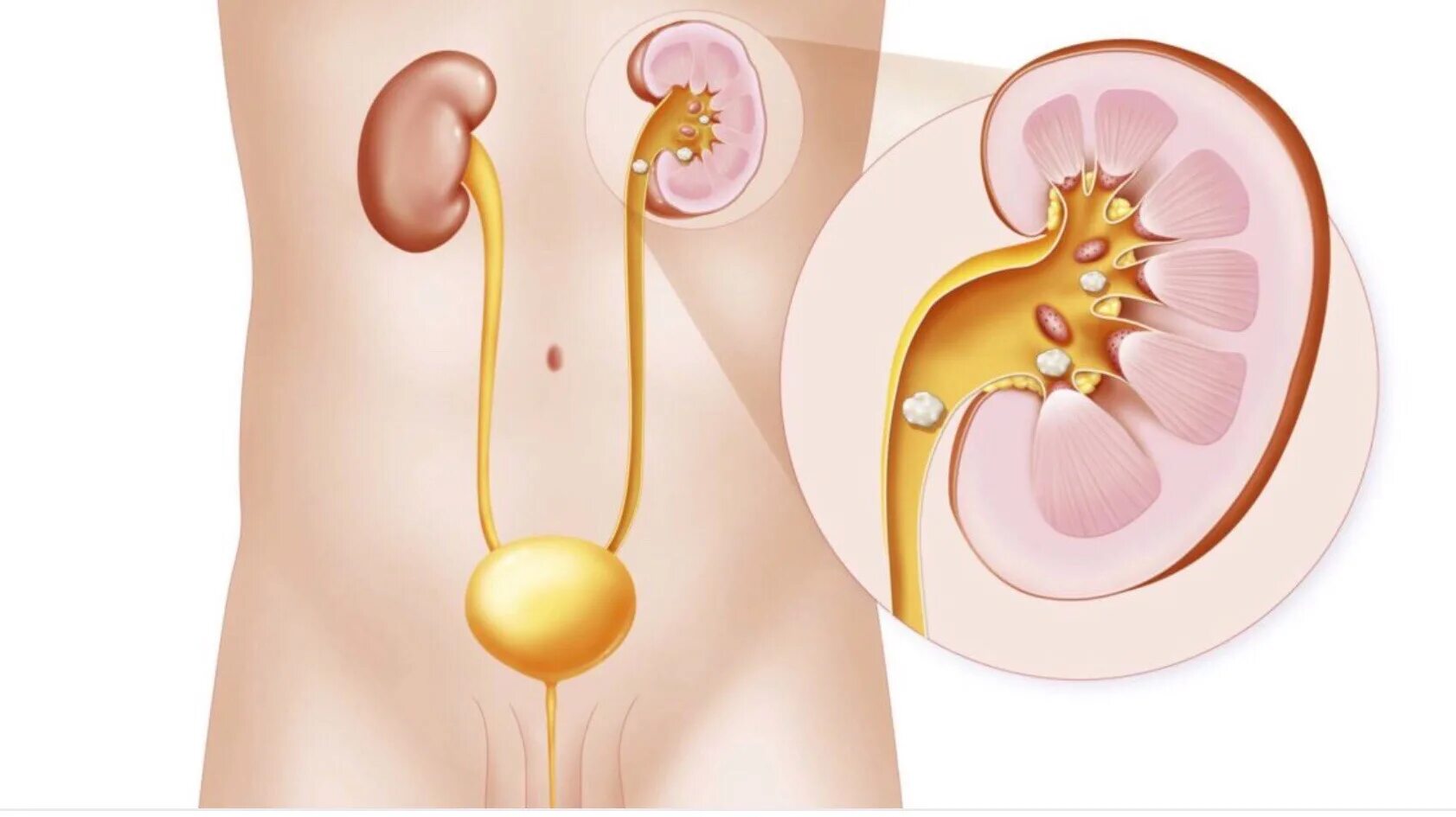 Канал мочеиспускания у женщин. Мочекаменная болезнь конкременты. Мочекаменная болезнь камни в почках. Мочекаменная болезнь анатомия. Камни в почках (конкременты).