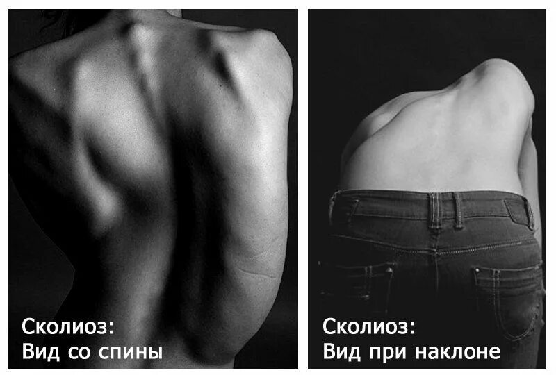 Сколиоз получить инвалидность. Классификация сколиоза. пионер вид со спины. леви вид со спины.