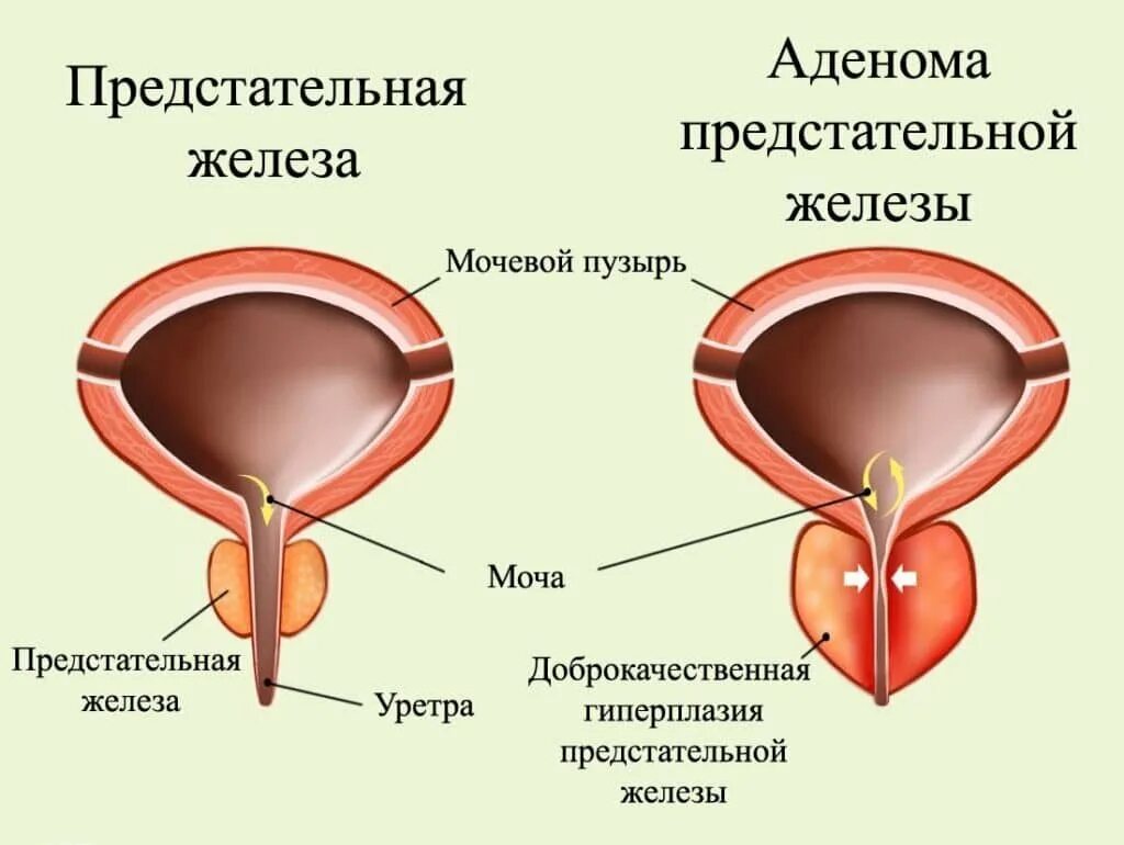 Аденома предстательной железы гиперплазия. Аденома предстательной железы симптомы. Аденома предстательной железы и ДГПЖ. Что такое аденома предстательной железы