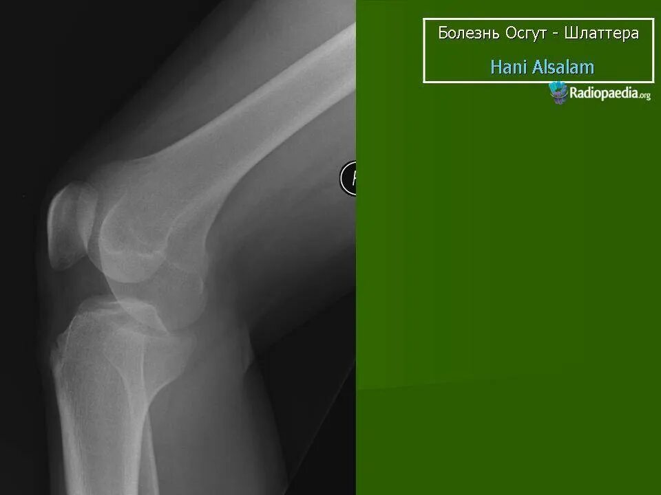 Шляттера мкб 10. Осгуд Шляттера болезнь. Болезнь Осгуд-Шлаттера рентген. Осгуда-Шлаттера рентген. Остеохондропатия Осгуда-Шлаттера коленного сустава.