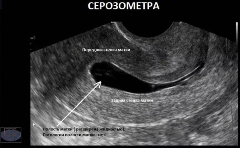 Полип эндометрия в матке на УЗИ. Серозометра эндометрия. Лечение серозометра матки после 60
