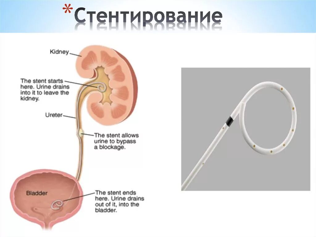 Катетер стент мочеточниковый. Катетер стент мочеточника. Стент внутреннего дренирования почки. Стентирование мочеточника стентирование мочеточника. Снятии стента