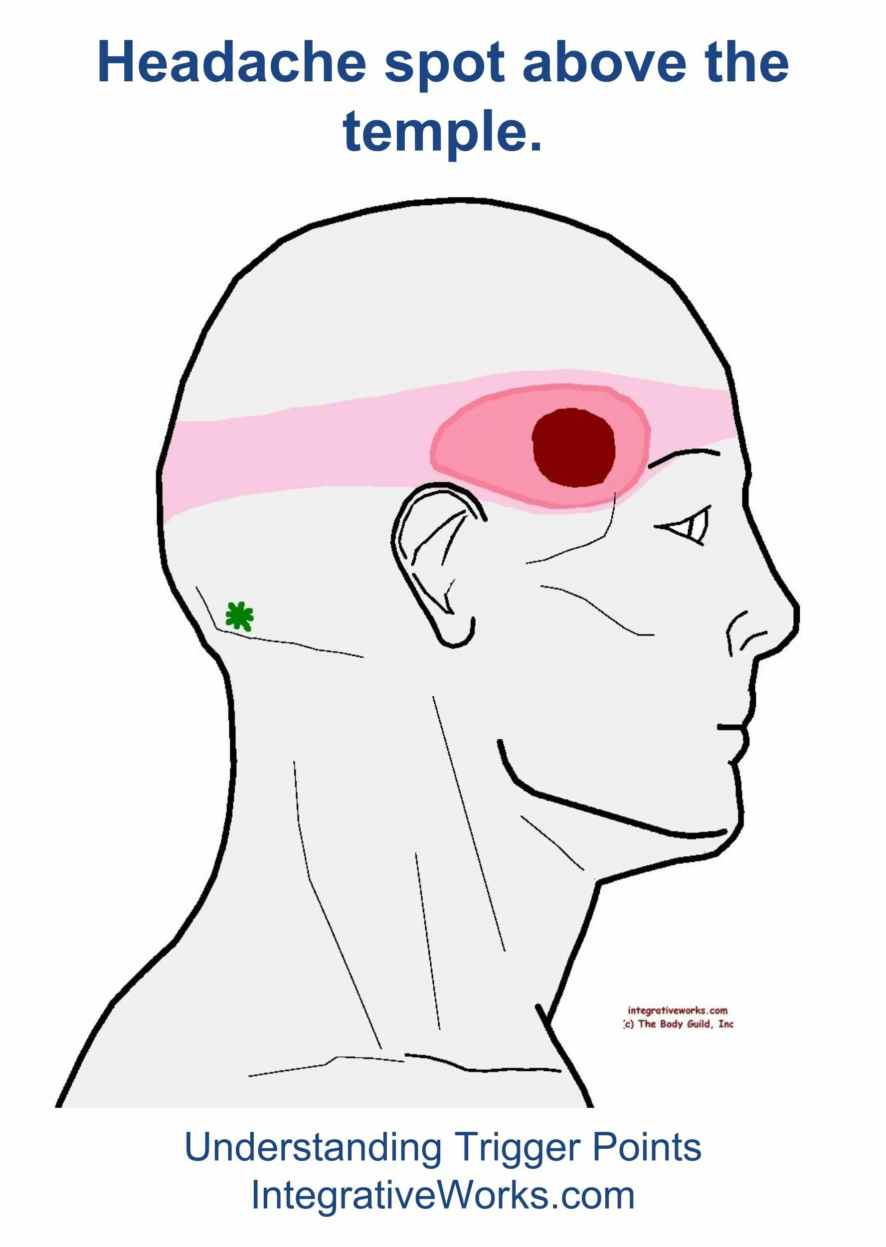 Головная боль. Боль в голове. Точки головной боли. Висок часть головы.