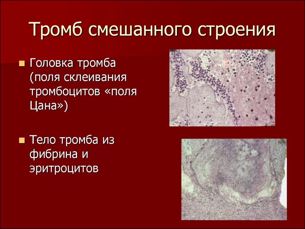 Смешанный тромб. Строение смешанного тромба. Тромб строение головка. Смешанный тромб головка тело и хвост.