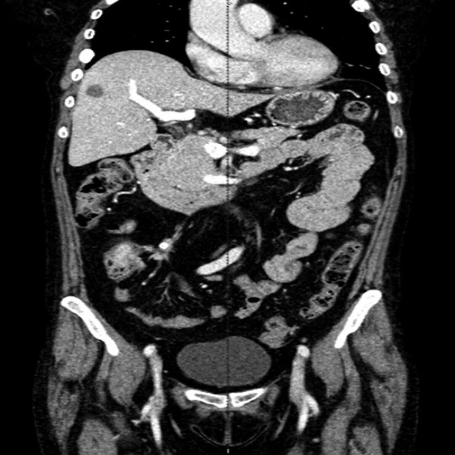 Кт с контрастированием брюшной полости контрастированием органов. Брюшная полость и забрюшинное пространство кт. Исследование брюшной полости с контрастом. Конкременты поджелудочной железы кт. Кт брюшной полости с контрастом подготовка.