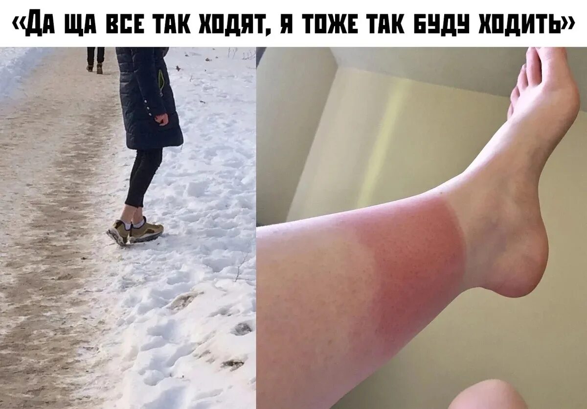 Ног нет а идет глаз нет. Щиколотки зимой. зимний загар ноги.