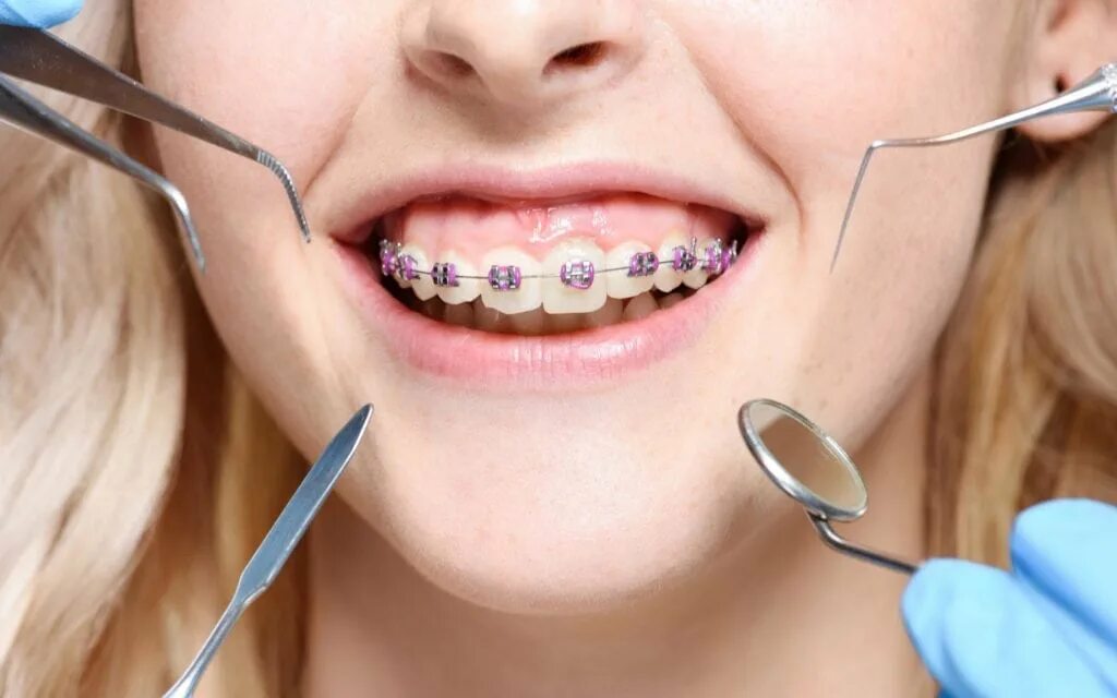 Damon clear брекеты. Брекеты. Брекеты clear21, oc orthodontics. Брекеты damon. Лучшие отзывы ортодонта.