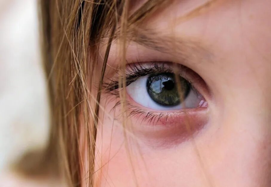 Темные круги у глаз ребенка. Ячмень и синяк под глазом. Ячмень под глазом у ребенка.