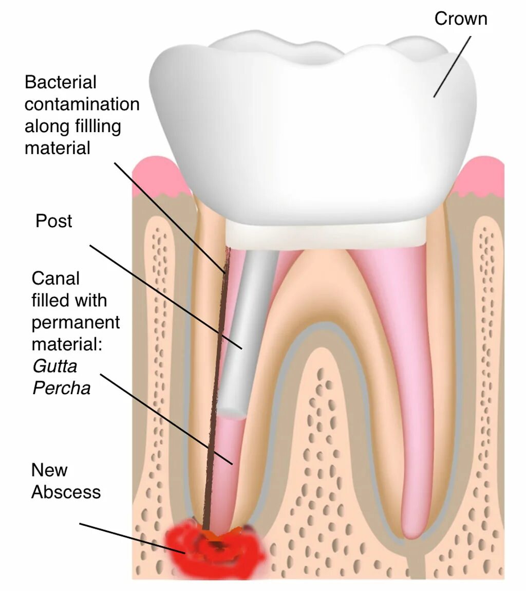 Распломбировка каналов зуба