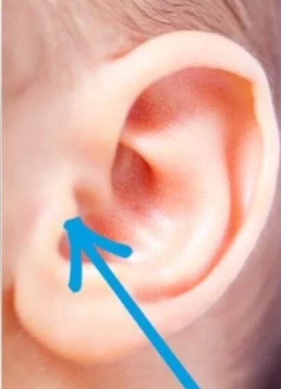 Болезни наружного уха: наружный отит. Как проверить отит у ребенка. Симптомы при отите у детей. Как проверить отит у ребенка. Как проверить отит у ребенка.