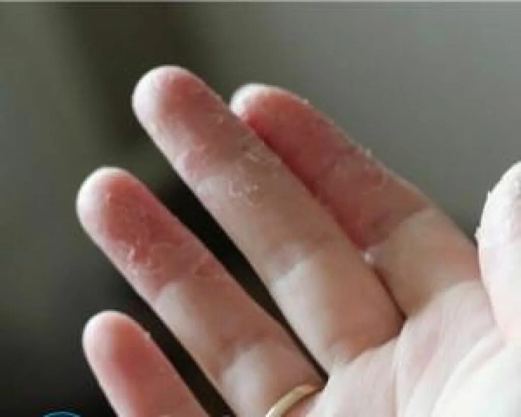 Сухость кожных покровов дефицит витамина. Отходит кожа на руках. Отходит кожа на руках. Отходит кожа на руках. Отходит кожа на руках.