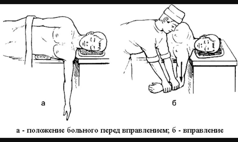 Как исправить вывих. Вправление вывиха плечевого сустава по джанелидзе. вправление вывиха плеча методом джанелидзе. джанелидзе вправление вывиха. метод джанелидзе вправление.