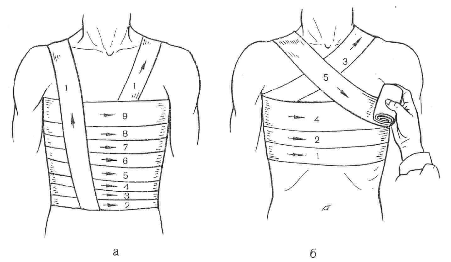 Перевязка при переломе ребер. Повязка при переломе ребер техника наложения. Перевязка при трещине ребра. Схема бинтования при переломе ребер. Как перебинтовать эластичным