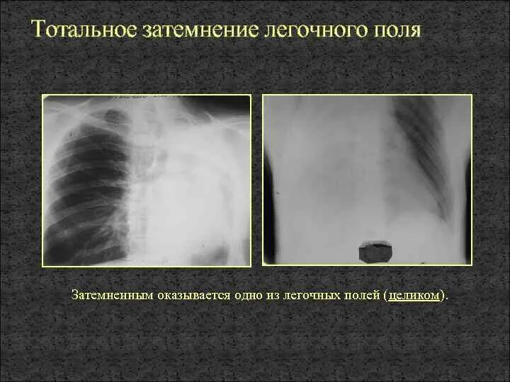 Округлое затемнение. Синдром обширного затемнения рентген. Тотальное затемнение на рентгене легких. Синдром затемнения легочного поля. Синдром субтотального затемнения легочного поля.