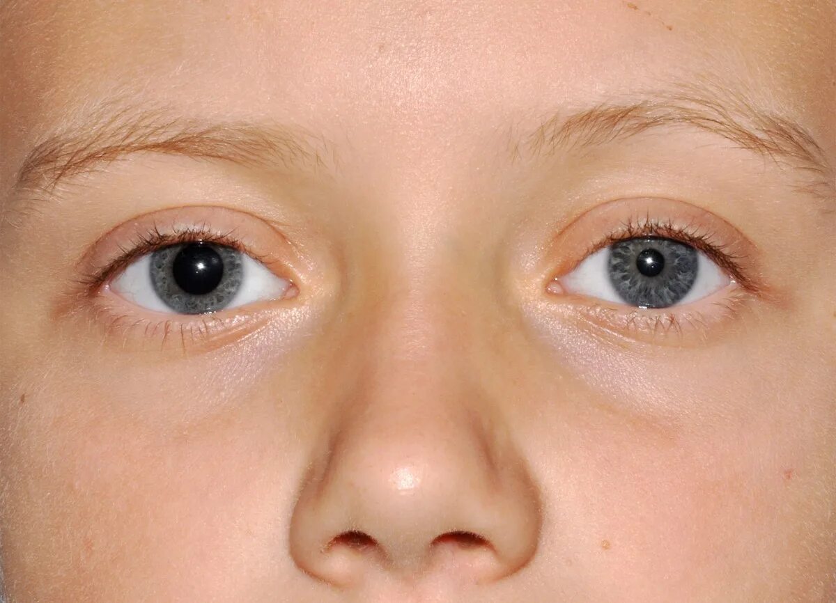 Миоз мидриаз анизокория. Анизокория врожденная. Левый глаз темнее правого