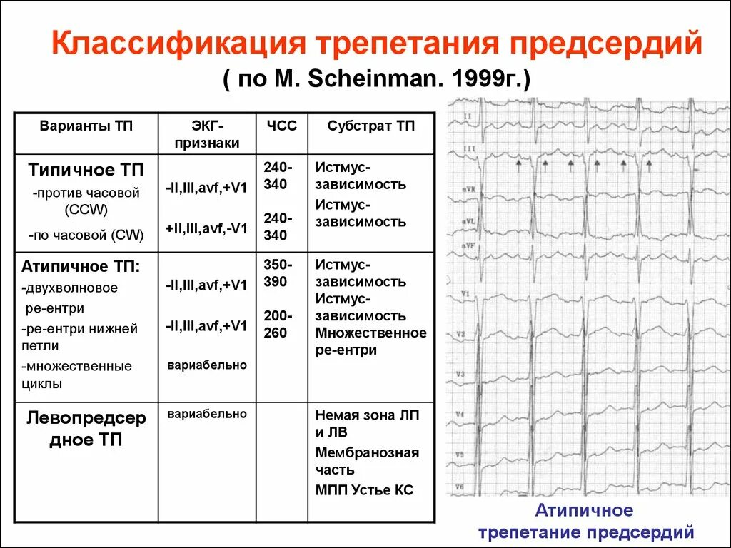 Формы трепетания предсердий на ЭКГ. Трепетание предсердий правильная форма чсс120. Атипичное трепетание предсердий на ЭКГ. Трепетание предсердий классификация на ЭКГ. Формы трепетания предсердий