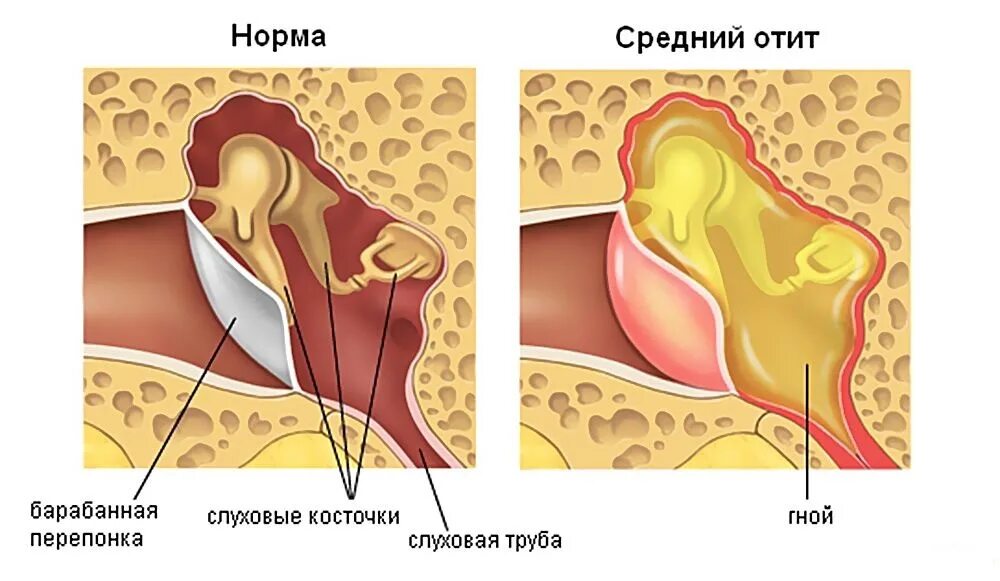 Атит что такое и как лечить. Атит что такое и как лечить