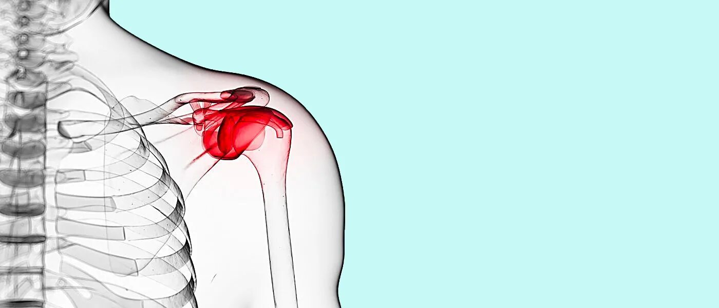 Плечевой периартрит что это. Периартрит, периартроз.. Синдром плечелопаточный периартрит. Плечелопаточный периартрит хиджама. Плечелопаточный периартроз операция.