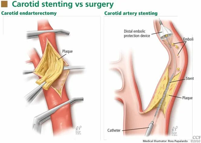Эндартерэктомия это. Эверсионная эндартерэктомия сонной артерии. Каротидная эндартерэктомия классификация. Операция каротидная эндартерэктомия. Каротидная эндартерэктомия сонной артерии ход операции.
