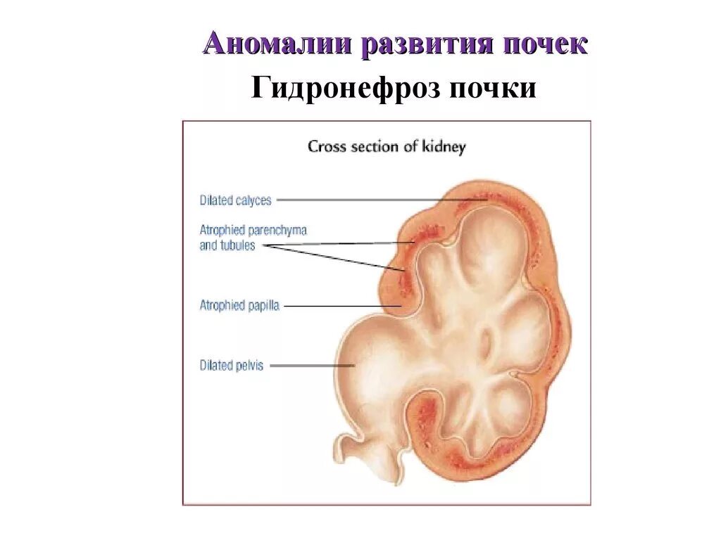 Заболевание почек гидронефроз. Строение почки гидронефроз анатомия. Аномалии строения почек. Строение почки гидронефроз.