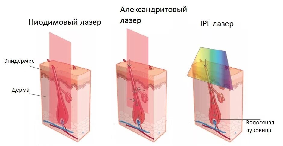 Лазер влияет. Принцип действия лазера для эпиляции. виды лазеров для лазерной эпиляции. воздействие диодного лазера на волос. виды александритового лазера для эпиляции.