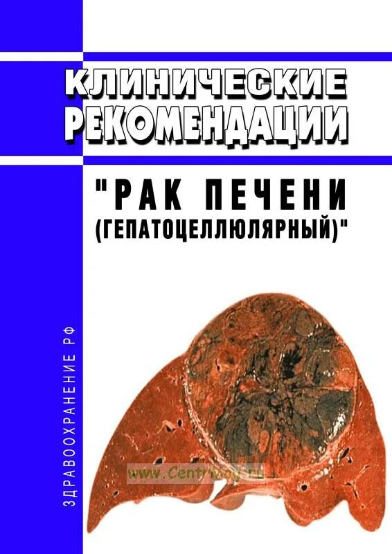 Гепатоцеллюлярная карцинома осложнения. Гепатоцеллюлярная карцинома печени. Гепатоцеллюлярная карцинома этиология. Гепатоцеллюлярный рак печени клинические рекомендации. Гепатоцеллюлярный рак печени клинические рекомендации.