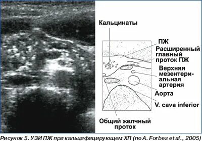 Расширение желчного протока