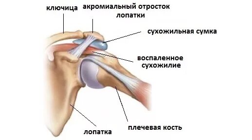 Сильная боль в плечевом суставе