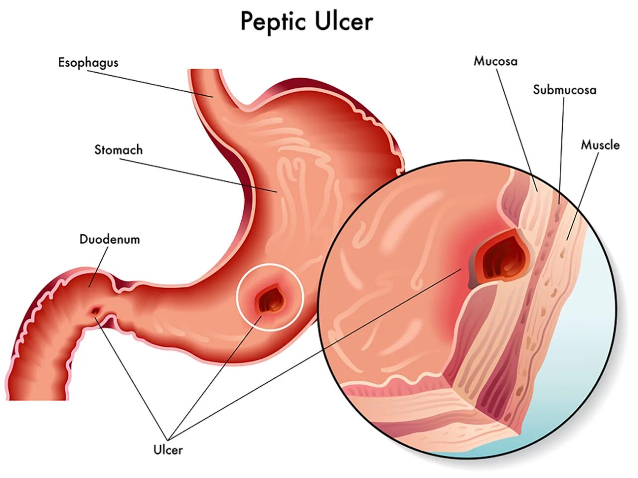 Подслизистый слой пищевода. Язвенная болезнь желудка и 12 перстной кишки. Язвенная болезнь желудка и двенадцатиперстной кишки ФГДС. Язвенная болезнь 12-перстной кишки ФГДС.