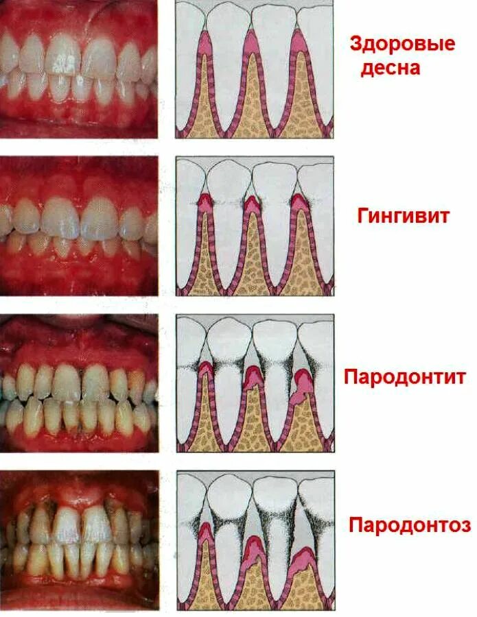 Почему сильно зуб. Хронический локализованный пародонтит. Десквамативный гингивит. Язвенно некротический гинг. Гангренозный пародонтит.