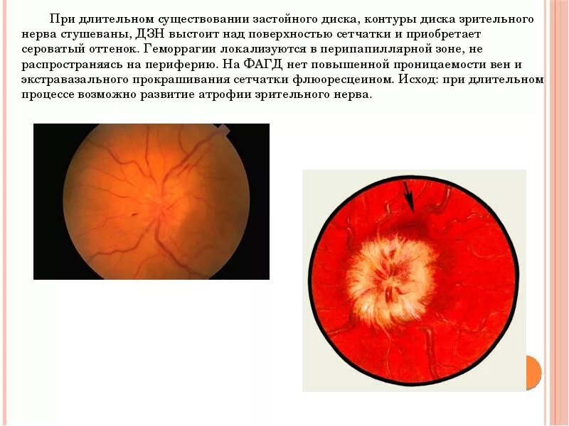 Ишемическая нейропатия глазное дно. Передняя ишемическая невропатия зрительного нерва. Нейрооптикопатия зрительного нерва. Ишемическая нейропатия сетчатки.