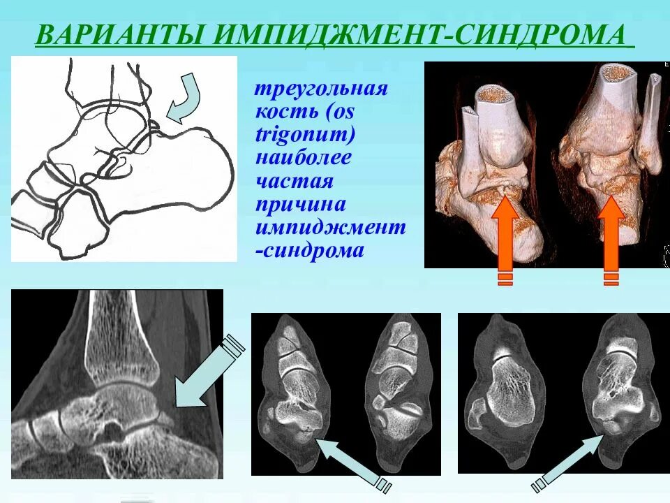 Синдромы голеностопного сустава. Импиджмент синдром таранной кости. Импиджмент синдром голеностопного сустава. Латеральный импинджмент синдром. Задний отросток таранной кости импиджмент.