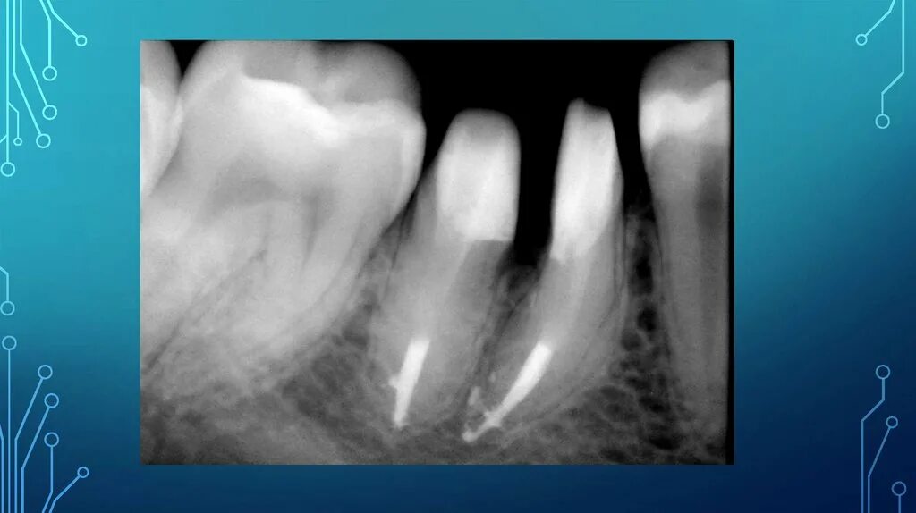 Фиброзный периодонтит. Фиброзный периодонтит рентген. Хронический фиброзный периодонтит клиника. Фиброзный периодонтит жалобы. Хронический фиброзный периодонтит исход.
